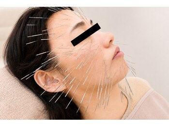 アンジェ あゆむ鍼灸院/鬼美顔鍼! 美容鍼
