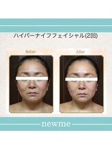 ニュウミー 諏訪本店(newme)/小顔　ビフォーアフター4