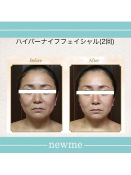 ニュウミー 諏訪本店(newme)/小顔　ビフォーアフター4