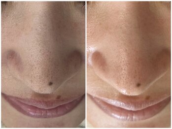 マヴィ 高槻店(MavY.)/ぷつぷつ黒ずみさようなら