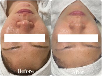 リアム(LiAm)/韓国美肌管理 ララピール