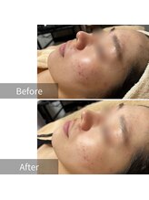 ヒヨリ(hiyori)/《before/after》毛穴洗浄