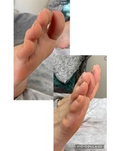 ノーマコルポ(noma corpo)/浮き指も改善！