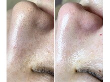 エヌエクラ(N.eclat.)/毛穴詰まり一掃