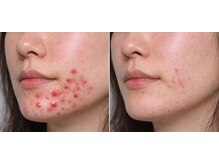 マロン(MARON)/【30代／顎ニキビ】改善例