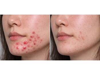 マロン(MARON)/【30代/顎ニキビ】改善例