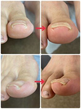 名古屋駅前巻き爪センター/陥入爪