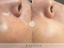 スパレーカ(Spa laka)/肌質改善