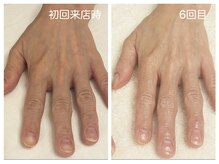 キレイテ 上野店/50代/6回目【ハンドケア上野】
