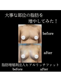クリニカルボーテ 心斎橋院(CLINICAL BEAUTE)/バレない、豊胸！？