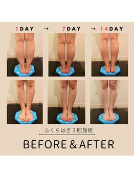 アオハル 東京(AOHAL)/ふくらはぎ集中痩身60分×3回