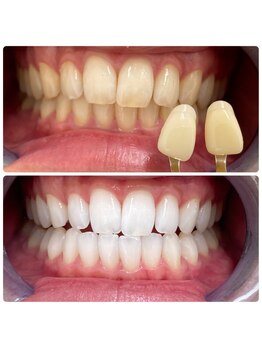 コナホワイトニング 神保町/ホワイトニング