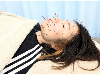 ひかる鍼灸整骨院/リフトアップ美容鍼