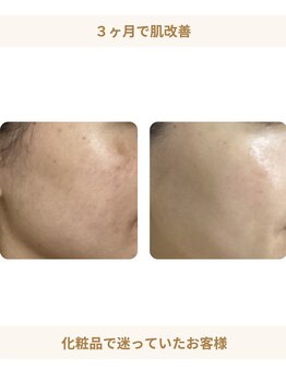 シェリーク 東京店/3ヶ月で肌改善