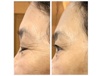 エルヴェ(Eleve)/目尻のシワ/ビフォーアフター