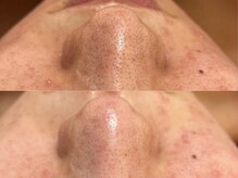 GRACETHOUSAND(グレイスサウザンド)/ハイドラ毛穴洗浄/毛穴吸引