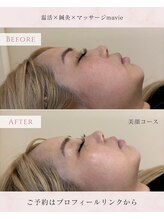 マヴィ(mavie)/美顔コースbefore→after