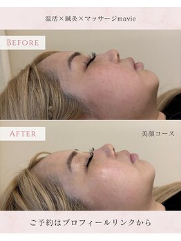 マヴィ(mavie)/美顔コースbefore→after