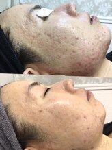 ステラルーテ(Stella lute)/凹凸もなめらかに