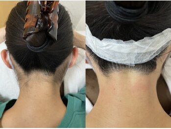 中国整体リラクゼーション 桜月/うなじ脱毛