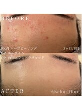 フローレ 豊田店(Flore)/繰り返すニキビケアに