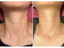 アプローズ(APPLAUSE)/年齢の出やすい首ケアも幹細胞