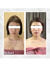 フローフシ∞/【小顔】30代女性症例写真