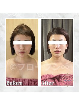 フローフシ∞/【小顔】30代女性症例写真
