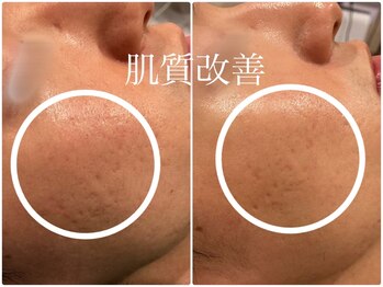 アモール(AMOR)/サーマトリックス[肌質改善2]