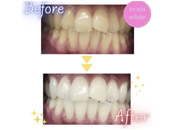 エクシアホワイトニング 静岡駅前店/ビフォーアフター