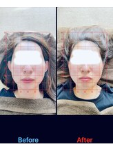 トーラス 整体(TORUS)/フェイスライン引き上げ