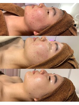 プレジール(plasir)/ニキビケア