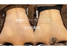 ライフサロン 天神(Life Salon)/背中のハーブピーリング