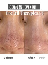 レイ(Rey)/プロセルフェイシャル鼻開き毛穴