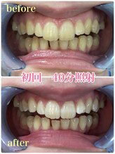 プラチナムビューティー 川口駅前店(PLATINUM BEAUTY)/初回から白さ実感お約束します！