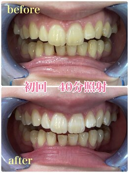 プラチナムビューティー 川口駅前店(PLATINUM BEAUTY)/初回から白さ実感お約束します！