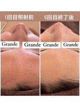 グランデ(Grande)/プラズマニアで本気の肌質改善◎