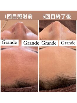 グランデ(Grande)/プラズマニアで本気の肌質改善◎