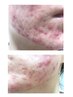 【最先端ニキビケア】脂性肌、角質肥厚でお悩みの方向けピーリング