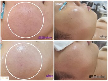 ピウリ(PIURI)/水光ピーリングで毛穴ニキビケア