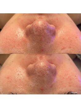 クリスタルビューティ 渋谷/【LHALALAララピール】