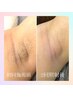 【3週間以内26歳以上】全身脱毛（顔・VIO含む） ¥15,800→¥9,800