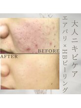 美バリ 新宿店(美BARI)/HBピーリング　4回