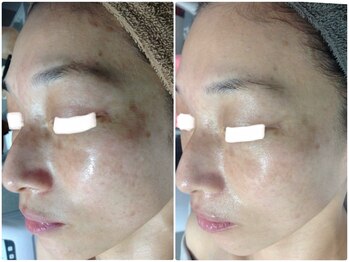 ルノン(LUNON)/ビフォーアフター集