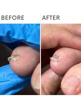 クオッカ(Quokka)/割れ爪ケア