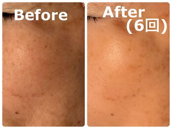 スイ 昭島店(Sui)/ハーブピーリング/シミケア/美白