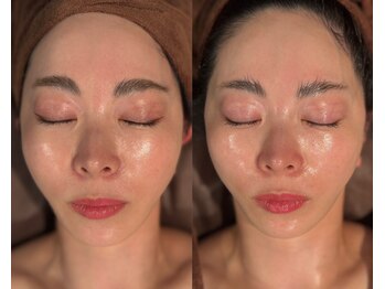 シェリー トウキョウ 西葛西店(Cherie Tokyo)/エラスチンB/A /西葛西/たるみ