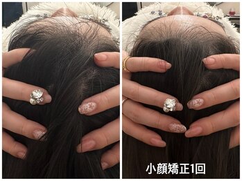 メゾンリュバン 天王寺(Maison Ruban)/小顔矯正