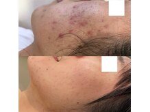 リット バイ マニミント(Litt by manimint)の雰囲気（原因を探り、TROIPEELとVVSで長年のニキビ改善へ。）