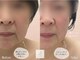 リル ビューティー ラボ(LILU BEAUTY LAB)の写真/切らずに小顔へ◎韓国人気の《オンダリフト》で二重あご・もたつきに◎理想のフェイスラインスッキリ小顔に